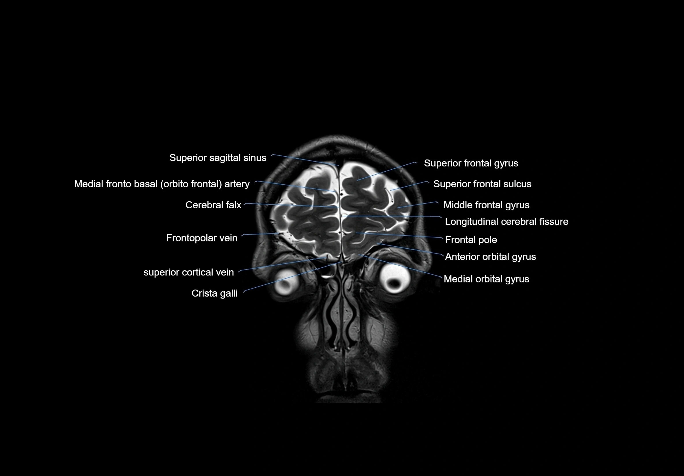 MRI Brain coronal cross sectional labelled anatomy 3T image  -img-00001-00009.webp